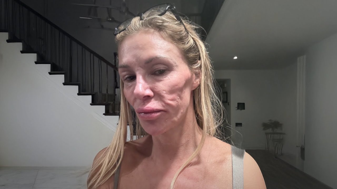 Brandi Glanville Says Parasite Is Jumping Around Her Face